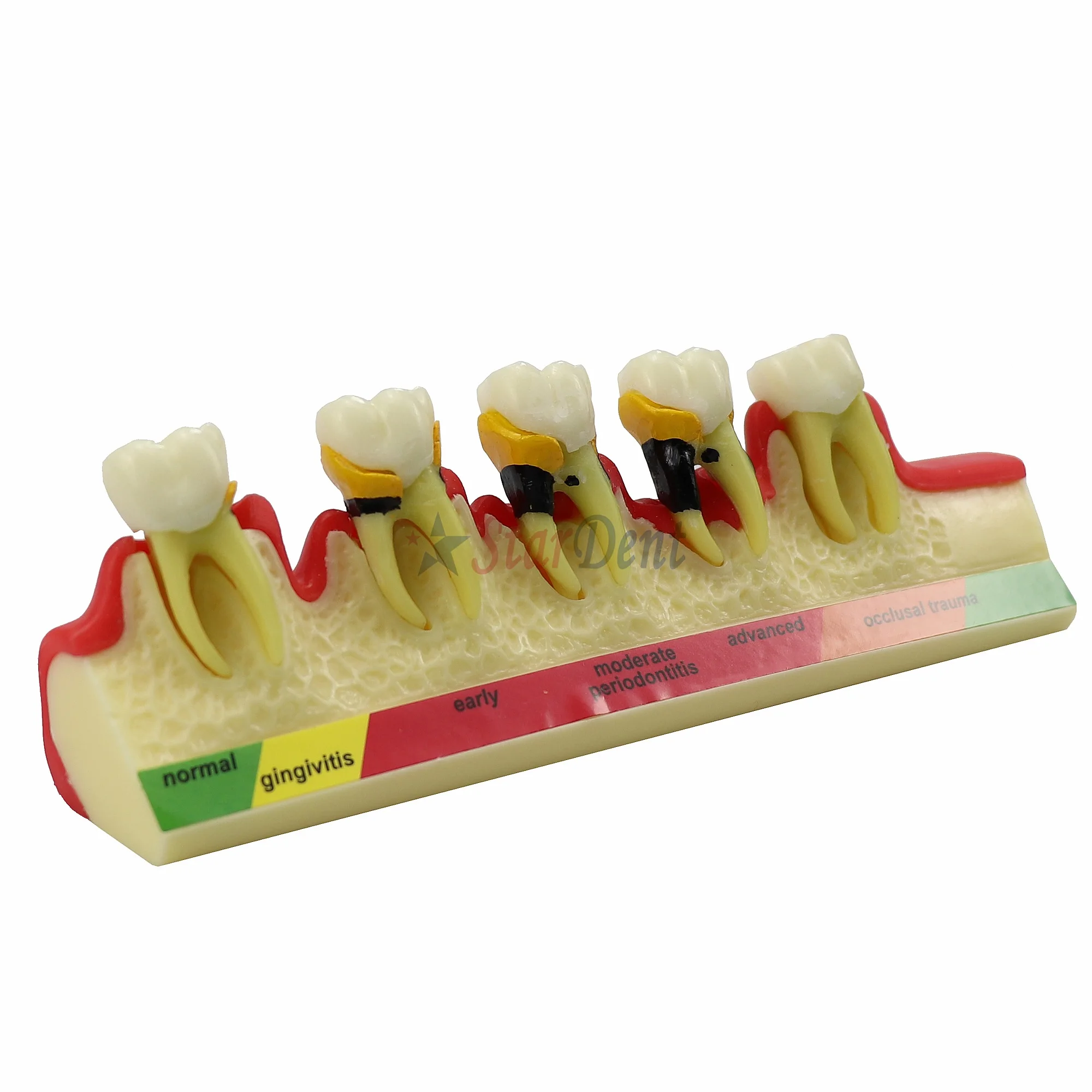 Periodontal Disease Model Resins Dentals Teeth Model for Student Teaching Denture Practice