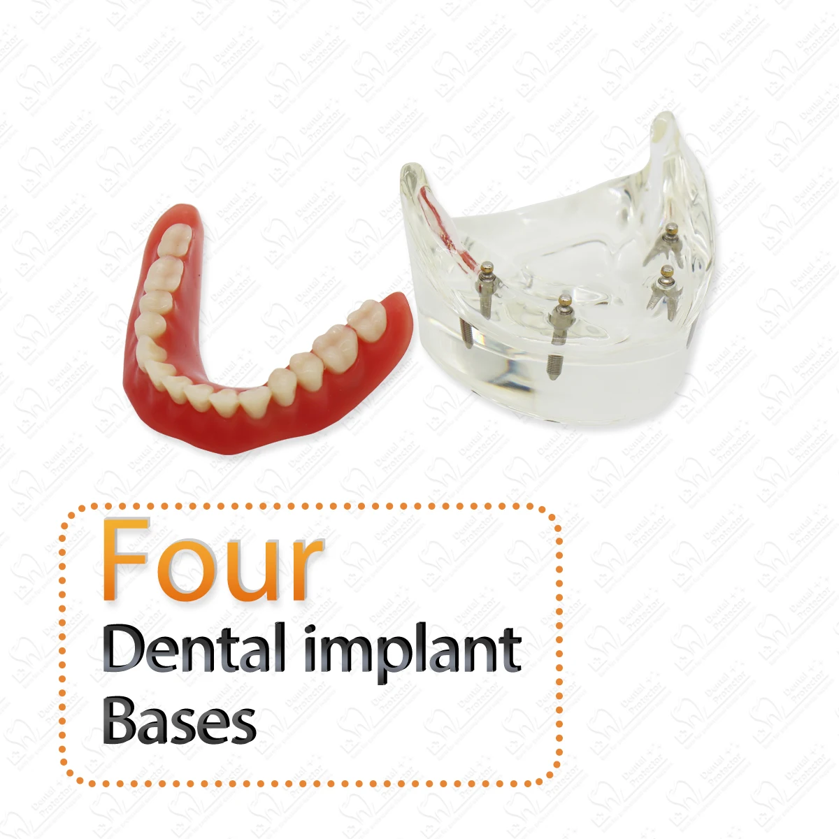 Dental Teeth Model with Implant Overdenture Inferior Demo Mandibular Model Dentist Student Learning Model