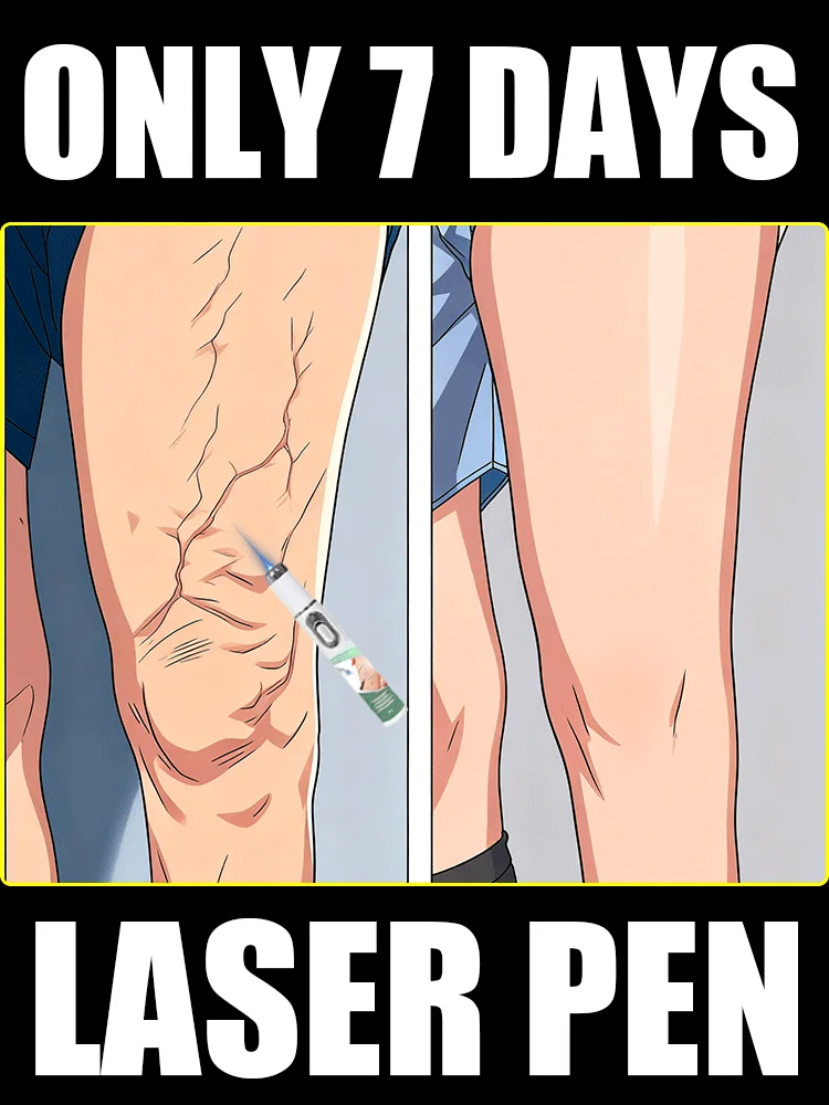 Generation-TWOND Laser Says Goodbye To Spider Legs Varicose In 7 Days
