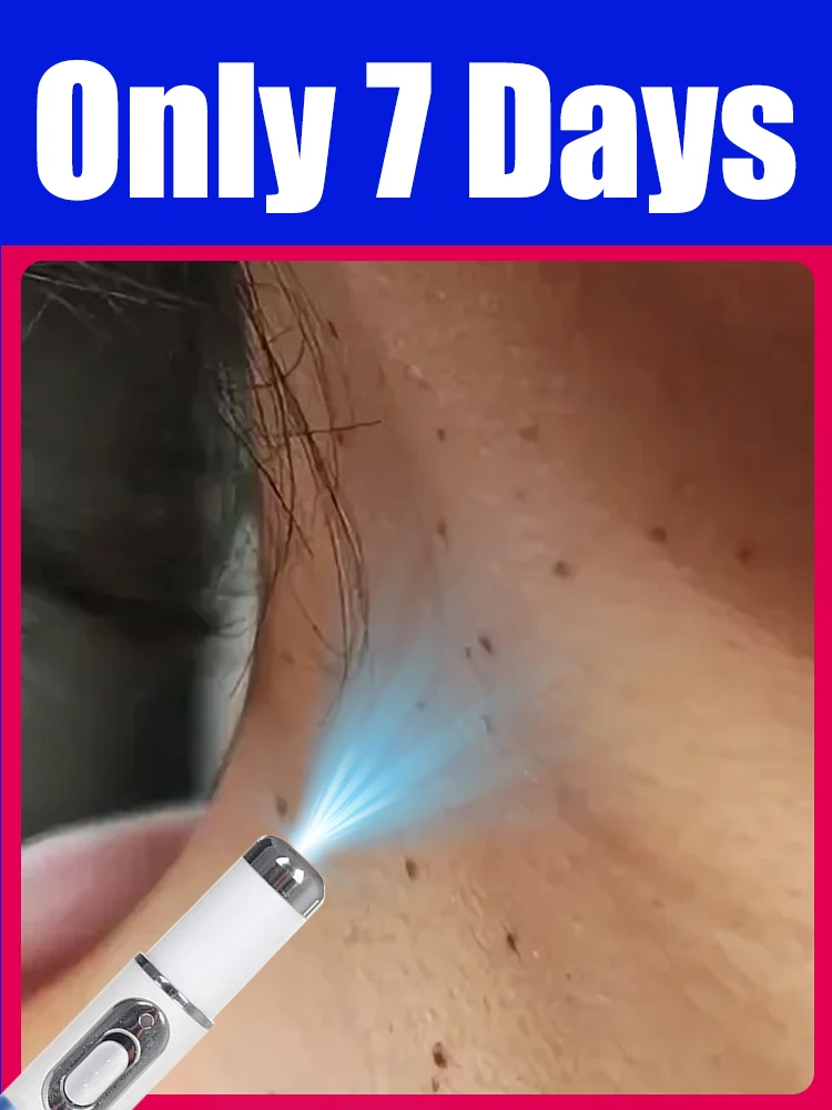 

Stop Warts blue light Pen Return for Smooth Skin.