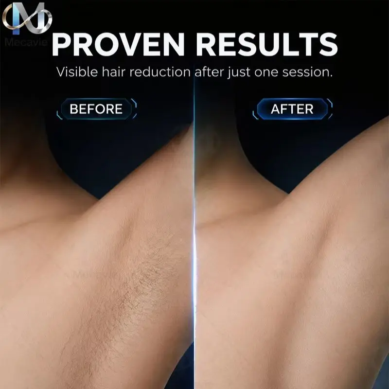 High Power 808nm Diode Laser Hair Removal Machine 755 808 940 1064nm Ice Cooling Fast Hair Removal Beauty Equipment