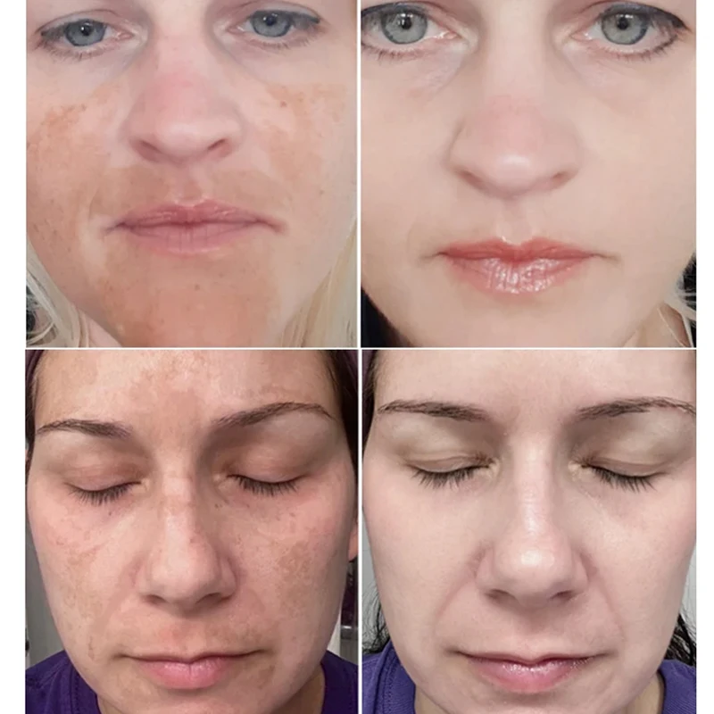 Whiten Freckle Cream Removal Melasma Dark Spots Pigmentation Serum Brightening Fading Spots Wrinkles Refreshing Moisturize Cream