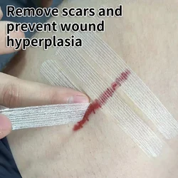 Steri Strip Wound Skin Closure Strips Surgical Sutures Postpartum Wound Repair Cosmetic Surgery Adhesive Medical Health Care