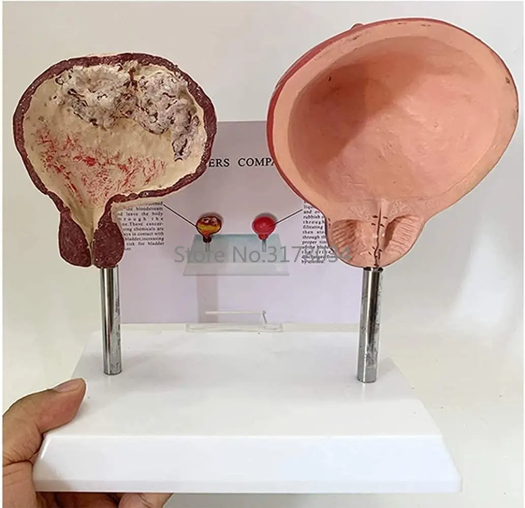 Human Urinary System Model Medical Anatomical Bladder Model Comparison Model of Smoking Bladder and Normal Bladder