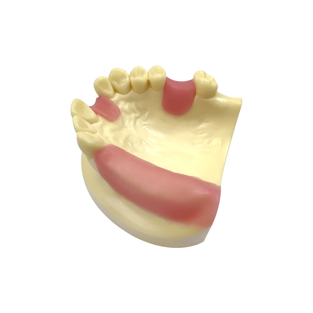 치과 Typodont 임플란트 연습 모델, 하악골 오버 틀니, 부드러운 잇몸 수리 데모, 클리닉 훈련 교육용