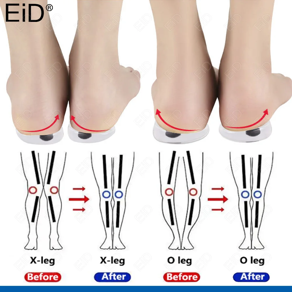 

1 Pair Magnets Silicon Orthopedic Insoles Foot Care Tool For Men Women Health Care O/X Type Legs Knee Varus Correction Heel Pads