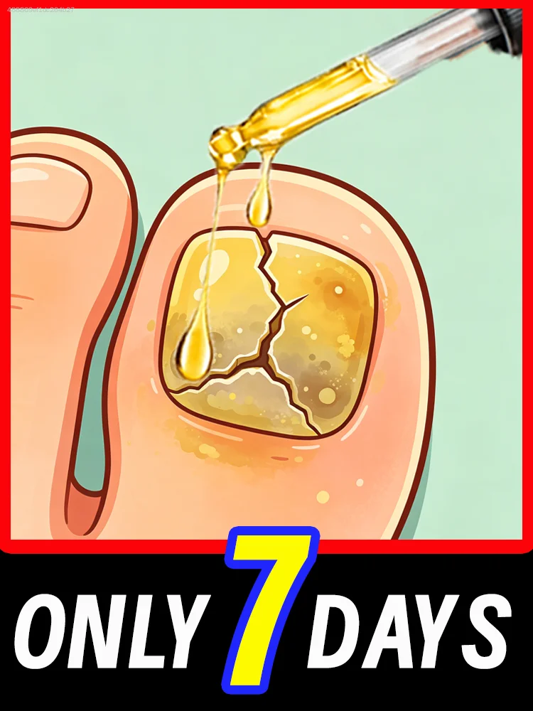 

Intensive ɴᴀɪʟ care to combat stubborn toenail ғᴜɴɢᴀʟ infections