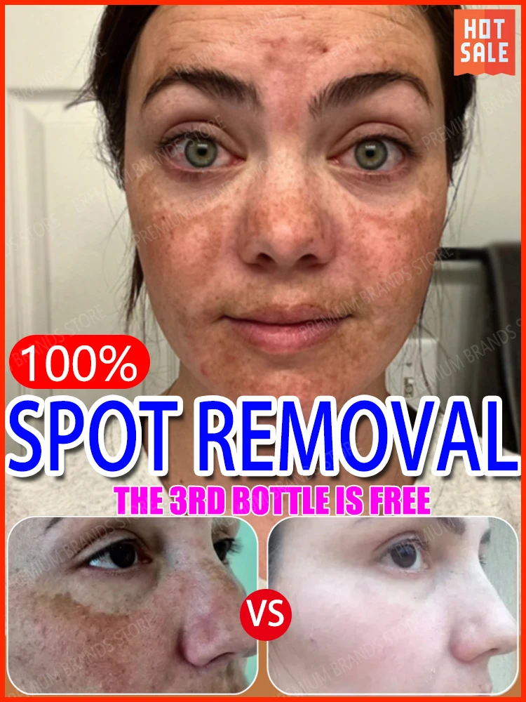 Dark Spot Removal Cream Melasma Freckle Removal Cream