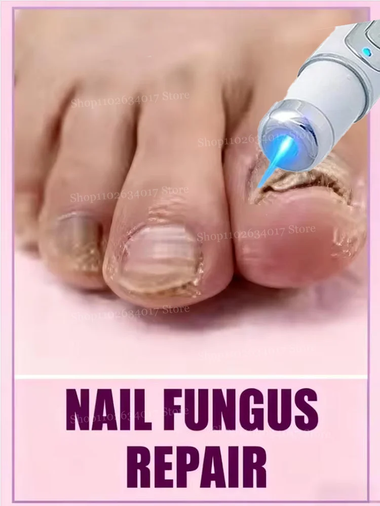 

Горячие продажи 2025: инструменты для чистки ногтей, лазерные инструменты с синим светом, ремонт корней, модернизированные второе поколение