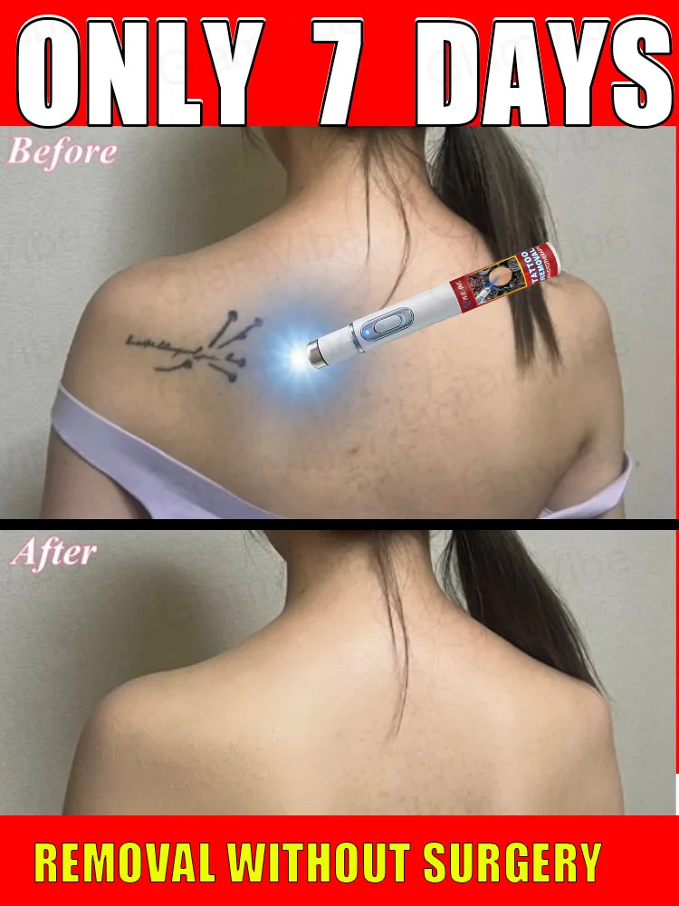 

Détatouage laser, détatouage sourcils, stylo détatouage, nettoyage en profondeur rapide et efficace des pigments