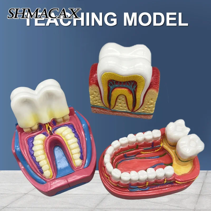 

Dental Caries Model Disease Teeth Dental Model For Dental Demonstration Model Clinic Ornaments Dentist Teaching Dental Lab Tool