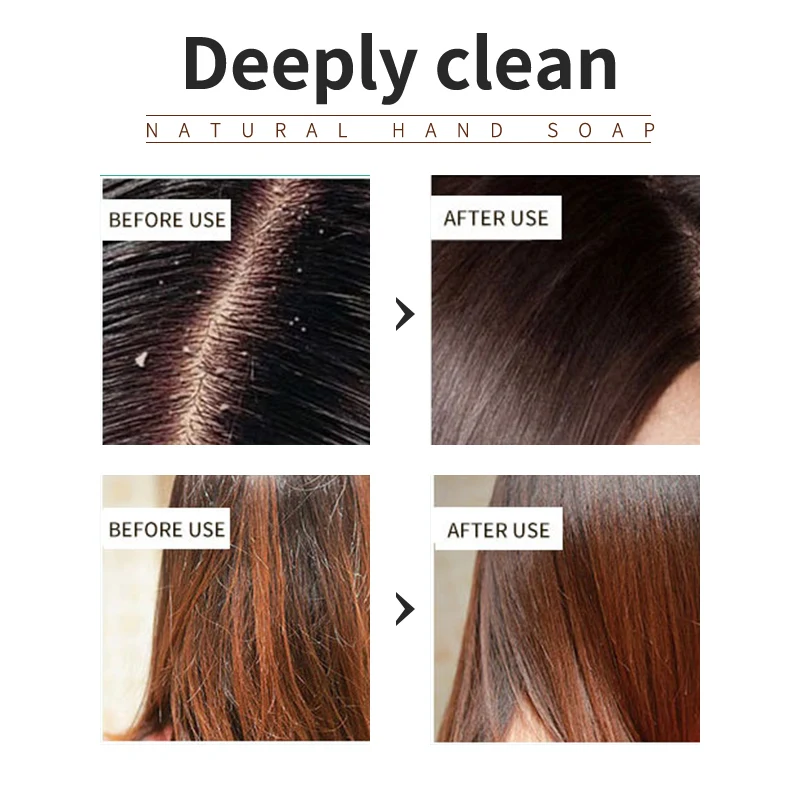 Tea Tree Essential Oil Plant Shampoo Is Refreshing, Oil Controlling, Dandruff Reducing, And Strong For Hair. Handmade Shampoo Wi