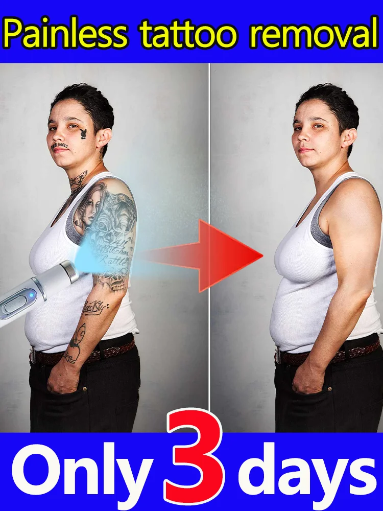 

Лазерное удаление татуировок может удалить любой размер, форма, рисунок или цвет.