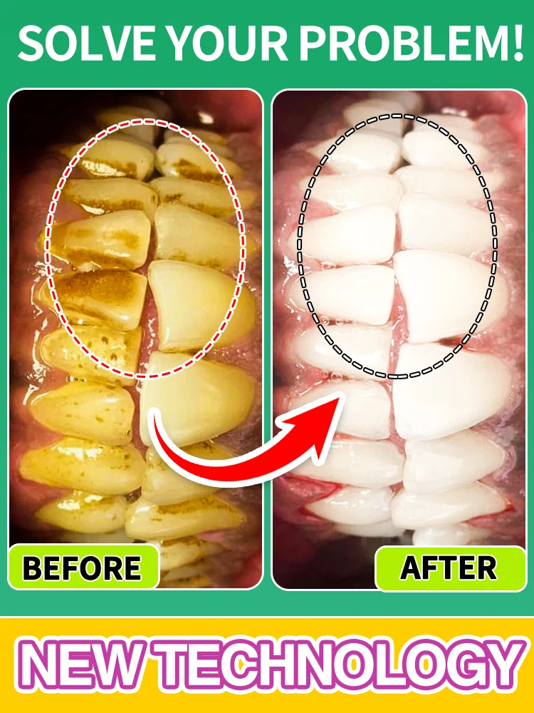 

Repair teeth, prevent tooth decay, and effectively remove dental plaque