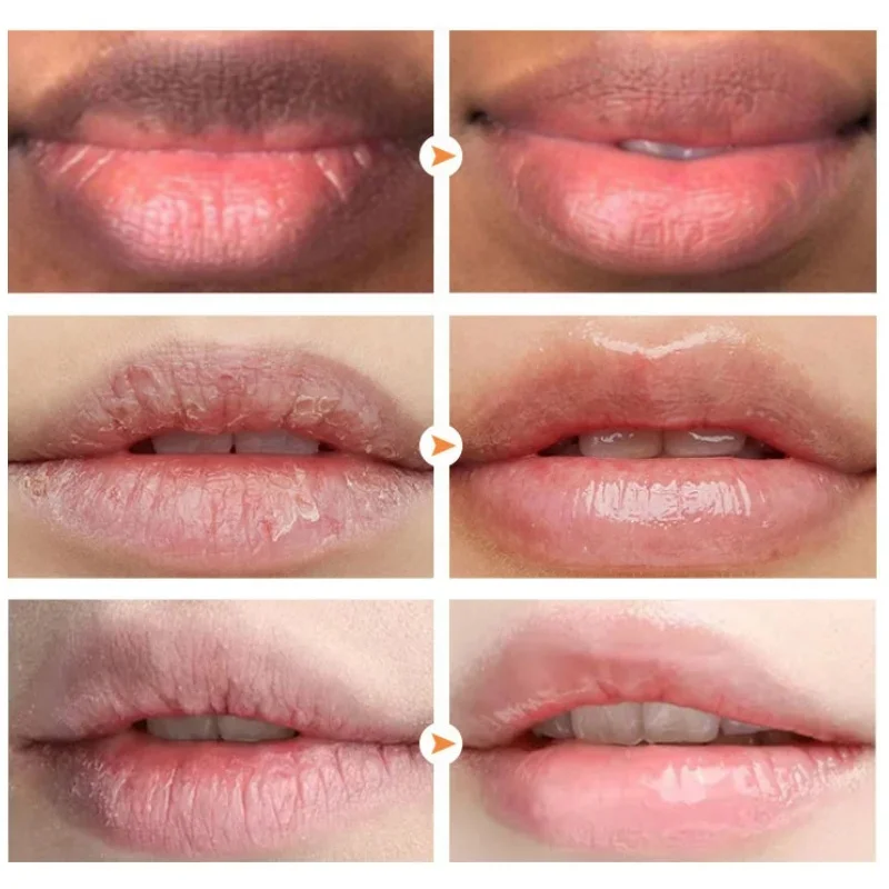 Lip Roze Frisse Bliksembleekcrème Behandeling Verwijderen Donkere Rook Lippen Lippenbalsem Whitening Vochtinbrengende Crème Voedende Essentie