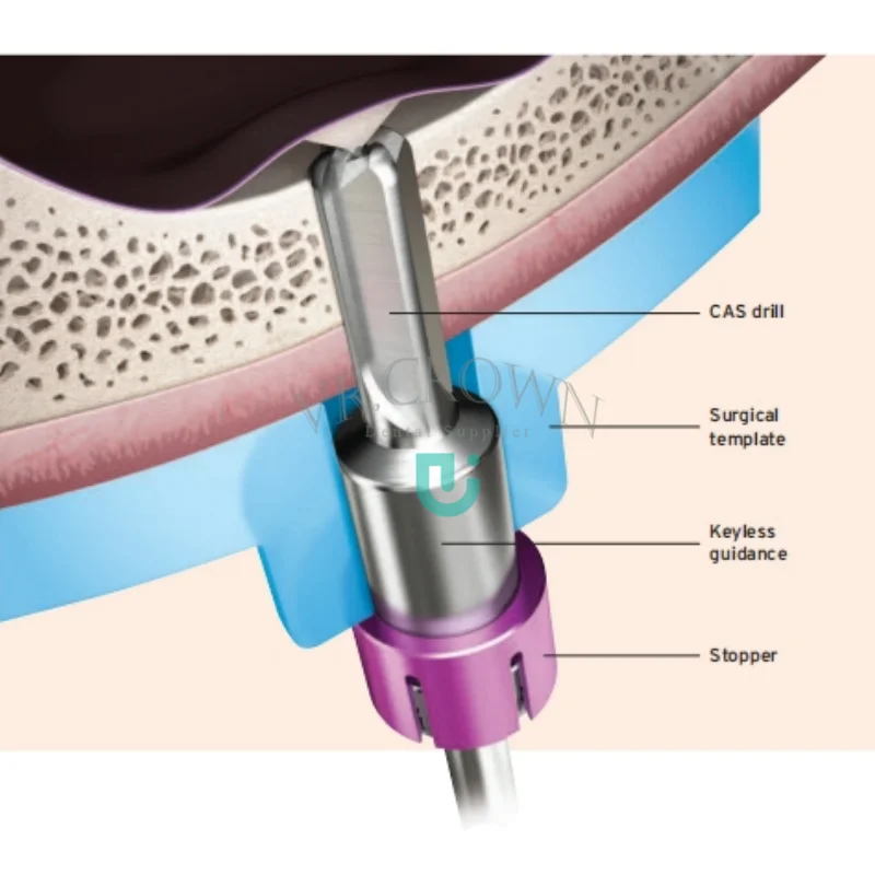 OneCAS Kit - Guided Sinus Lift Surgery Kit Osstem Implant Instrument Kits