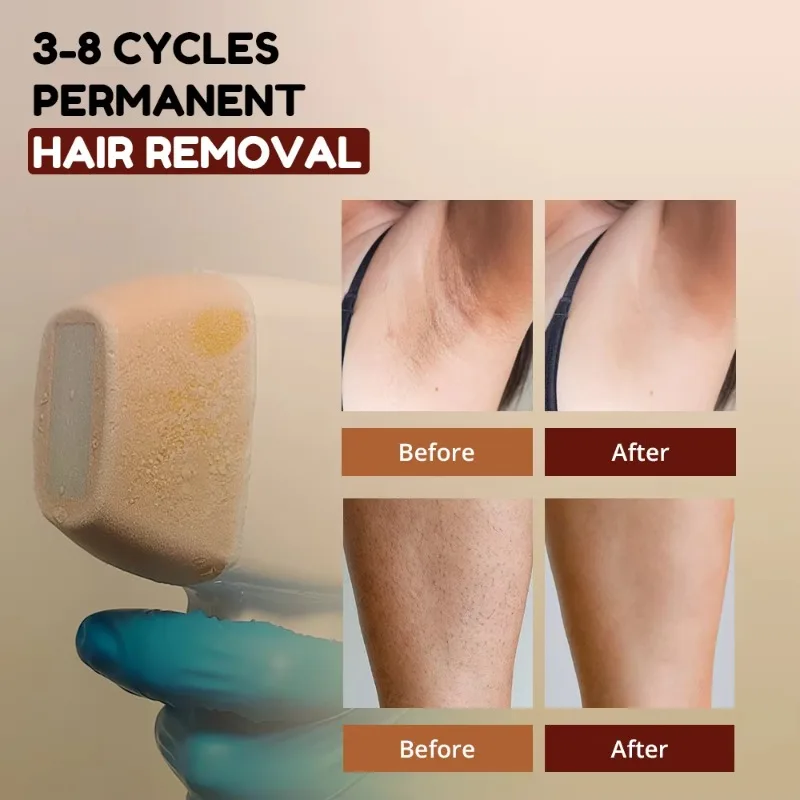 2000W Ultra-quiet Diode Laser Hair Removal 808nm 4D Titanium AI Skin Analysis Machine Professional Salon Use Epilator