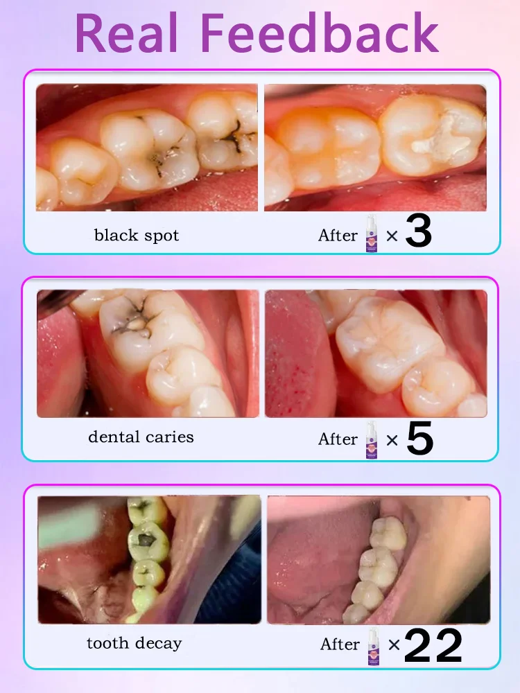 Anti Caries Repairing Cavities Tooth Decay Repair