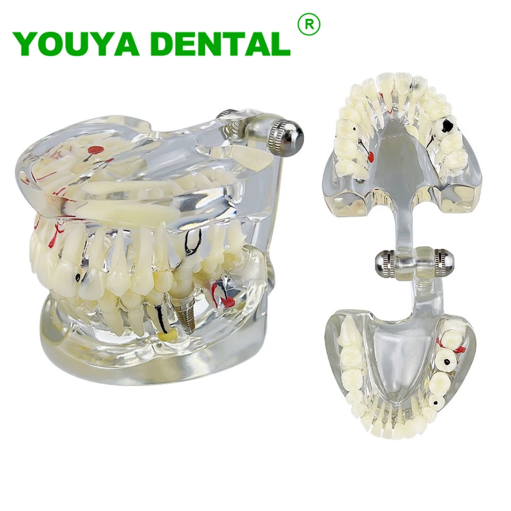 

Dental Disease Model Pathological Caries Teeth Model With Implant Dental Models For Patient Education Dentist Demonstration Tool