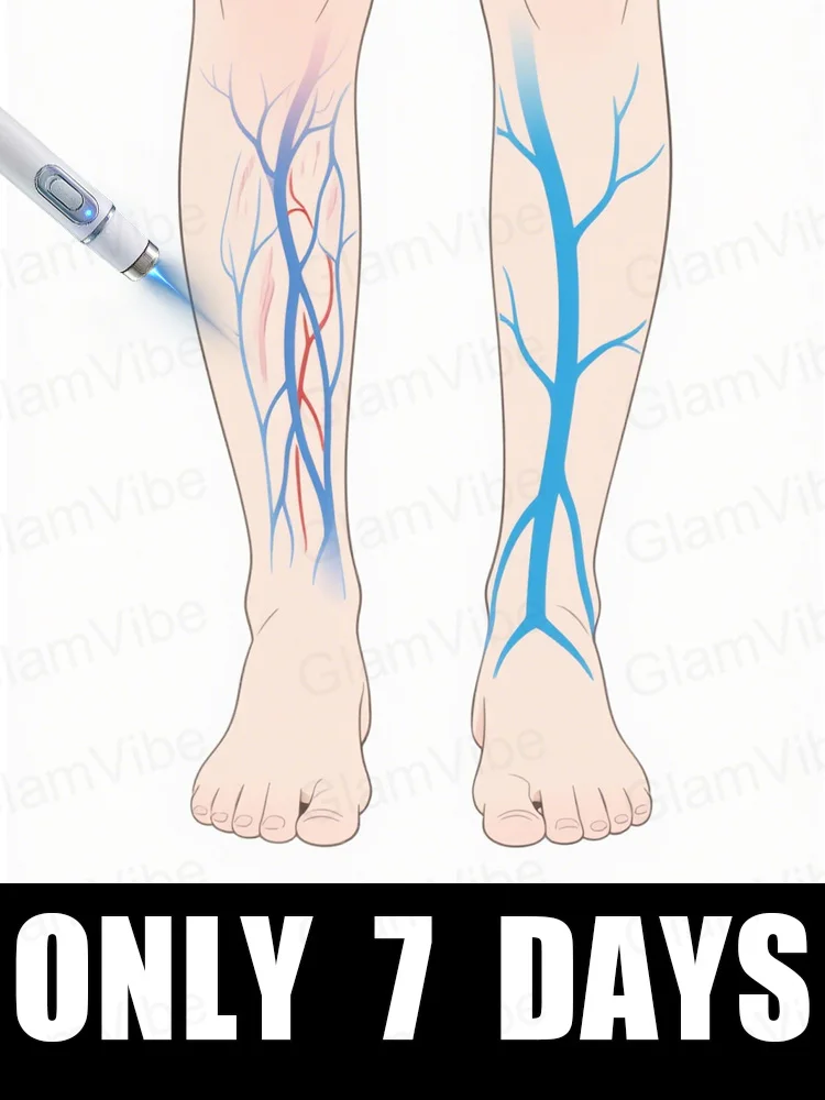 

Leg care tools, blue light pen, varicose veins, 2025 hot sale