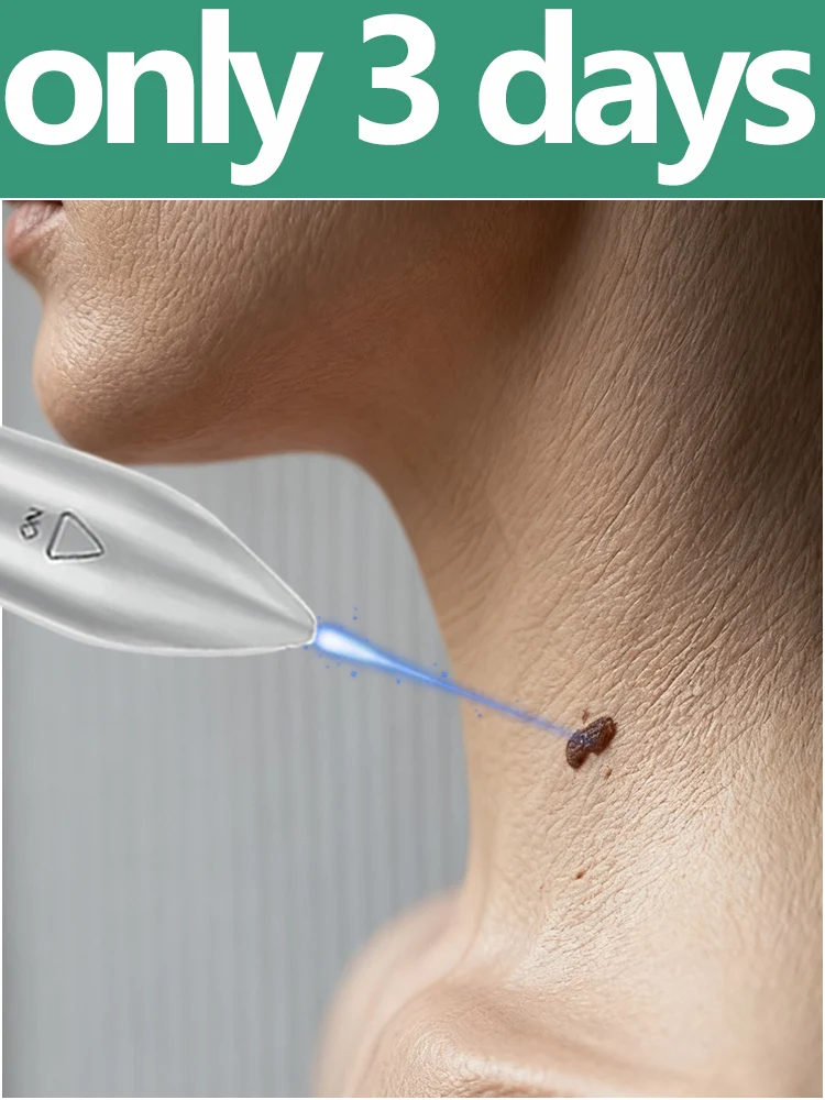 

Новое обновление 2025 года. Изделить задание. Инструменты для бородавок в 1 день. ЛАЗЕРНАЯ СВЕТНАЯ РУЧКА 3,2 В.