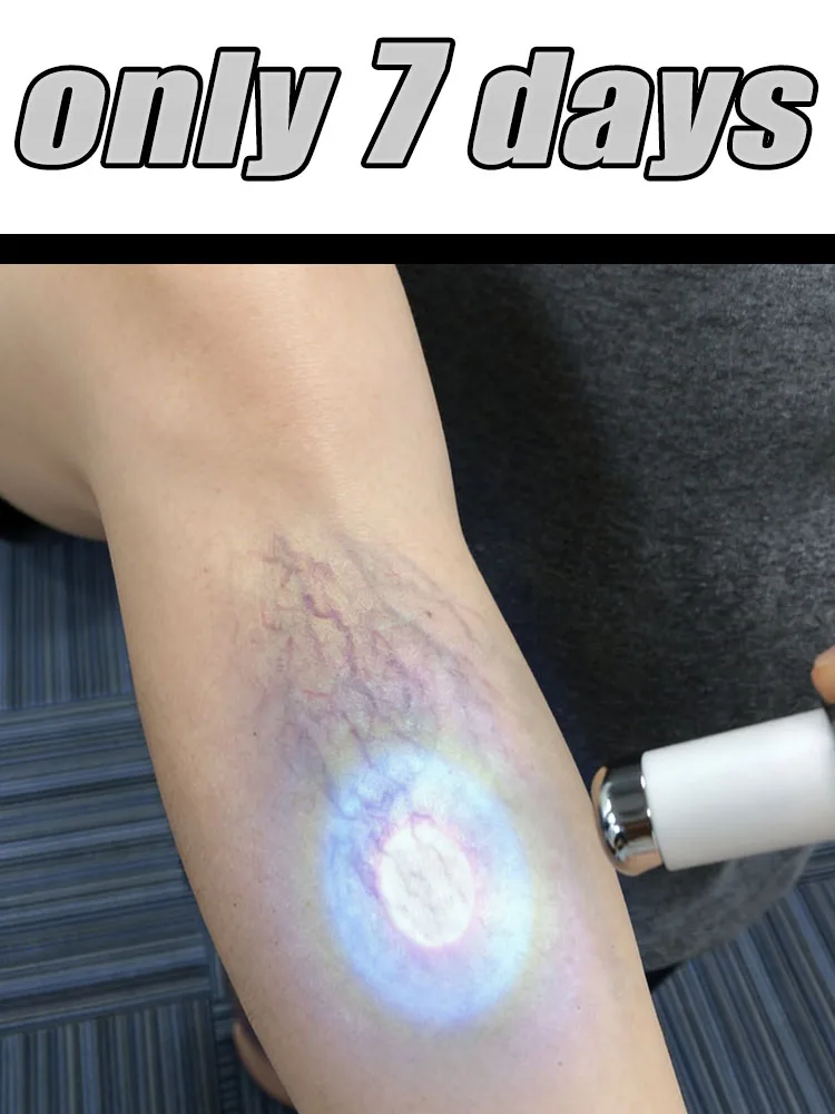 

Модернизированный легкий инструмент 2026 года. Второе поколение. Пожарное, чтобы проблемы ног в течение 7 дней. Ноги решают их проблемы и отсутствие проблем,