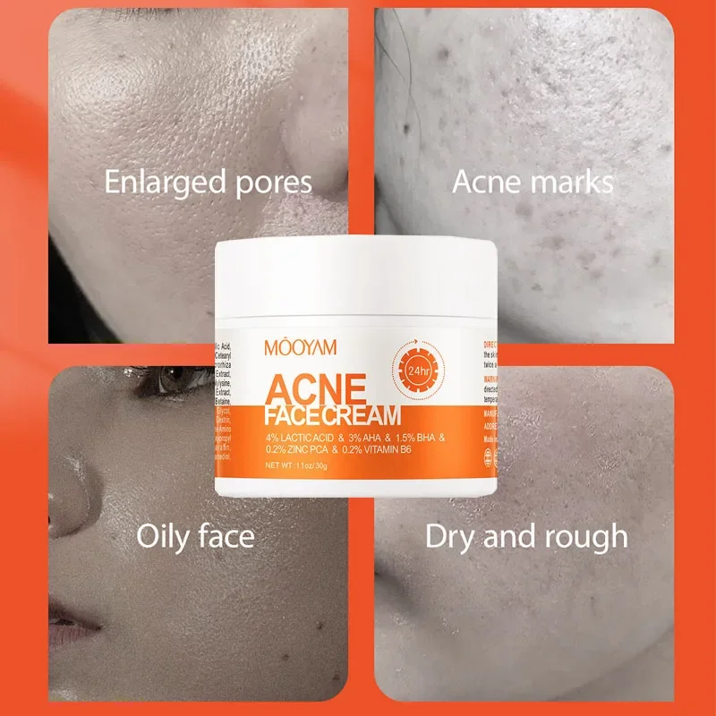 

Salicylic acid repair acne cream dilutes acne marks improves acne muscles removes closes the mouth Skincare