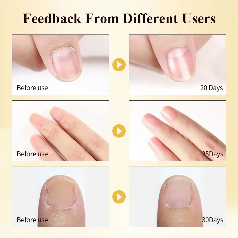 1 Set Repairing Serum Fine Good Durable Nails Repairing Serum Nourishing  Cracked Discolored Nails Essence Nail Treatment Liquid