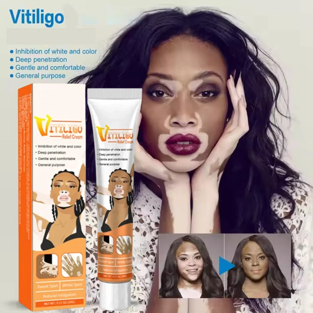 

Мазь для Vitiligo, средство для удаления черных точек на коже