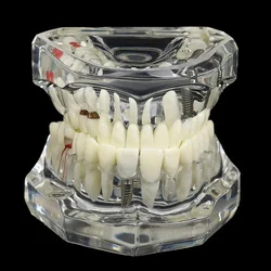 Dental Models Repairable Resin Models Of Diseased Teeth For Teaching And Research In Medicine And Dental Diseases