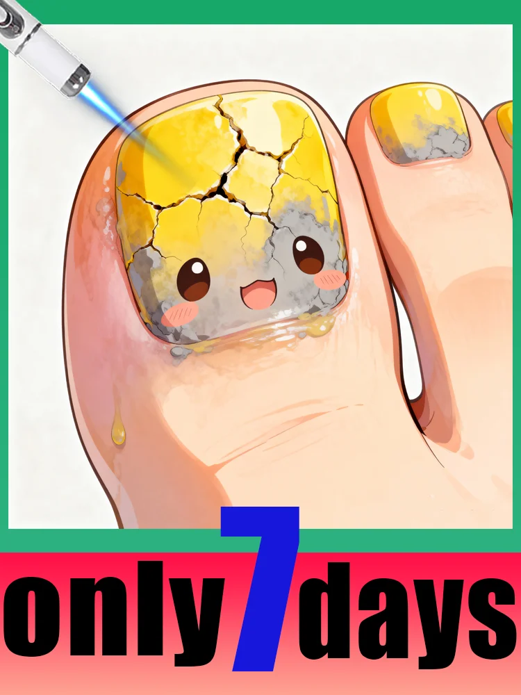 

Изменение технологии 2025 года — Протигрибковая технология — попрощайте онихомикоз с лазером