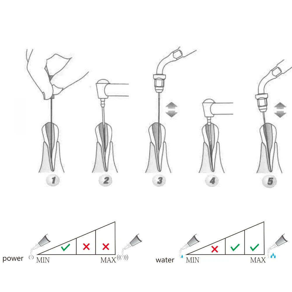 Punta de escarificador Dental ED1 ED2, punta de endodoncia para odontología, compatible con Scaler ultrasónico SATELEC/DTE para herramientas de limpieza de Canal radicular Anterior