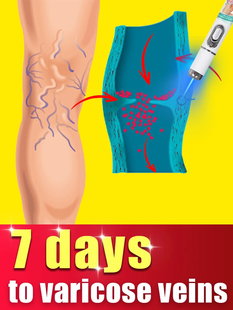 

Lower limbs care tools Reduce Uncomfortable For lower limbs Improving Blood Circulation Varicose Veins Pen Skin Care Product