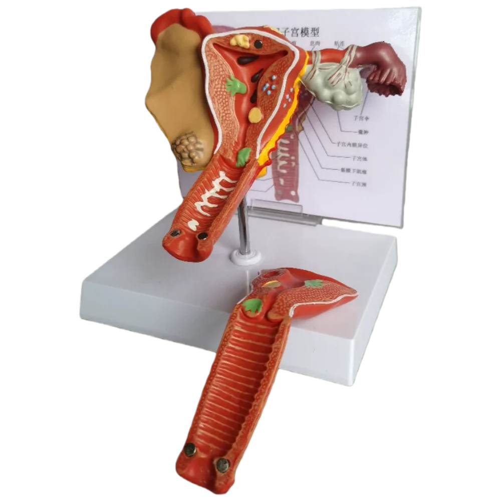 Medical Science Female Human Uterus Model Pathological Model