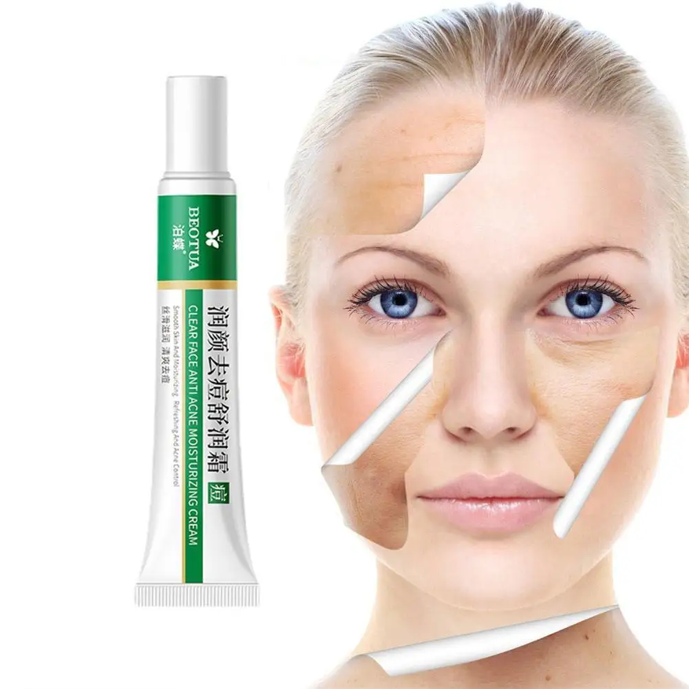 Herbal Anti Effective Acne Removal Cream Effective Acne Removal Cream Oil Control Whitening Moisturizing Face Gel Skin