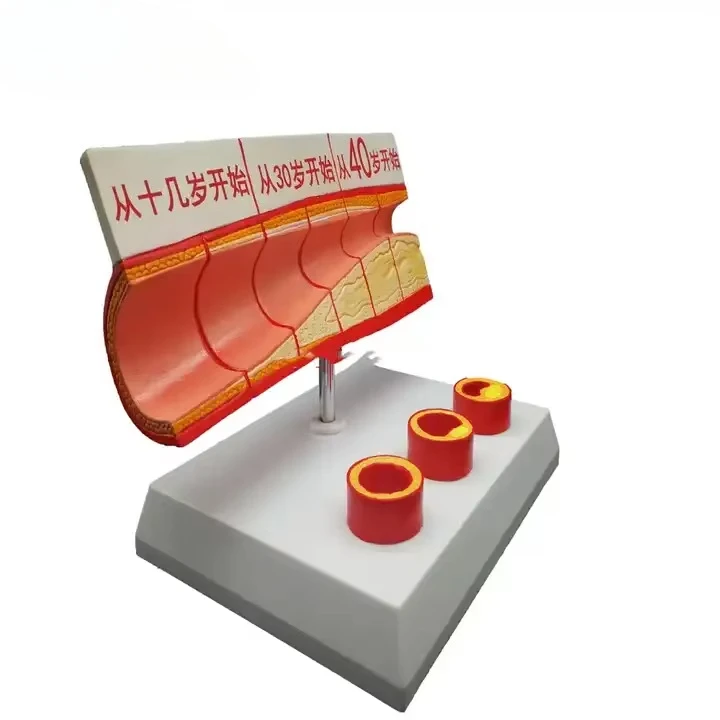 Anatomy Teaching of Coronary Atherosclerosis Thrombosis Model in Medical Disciplines