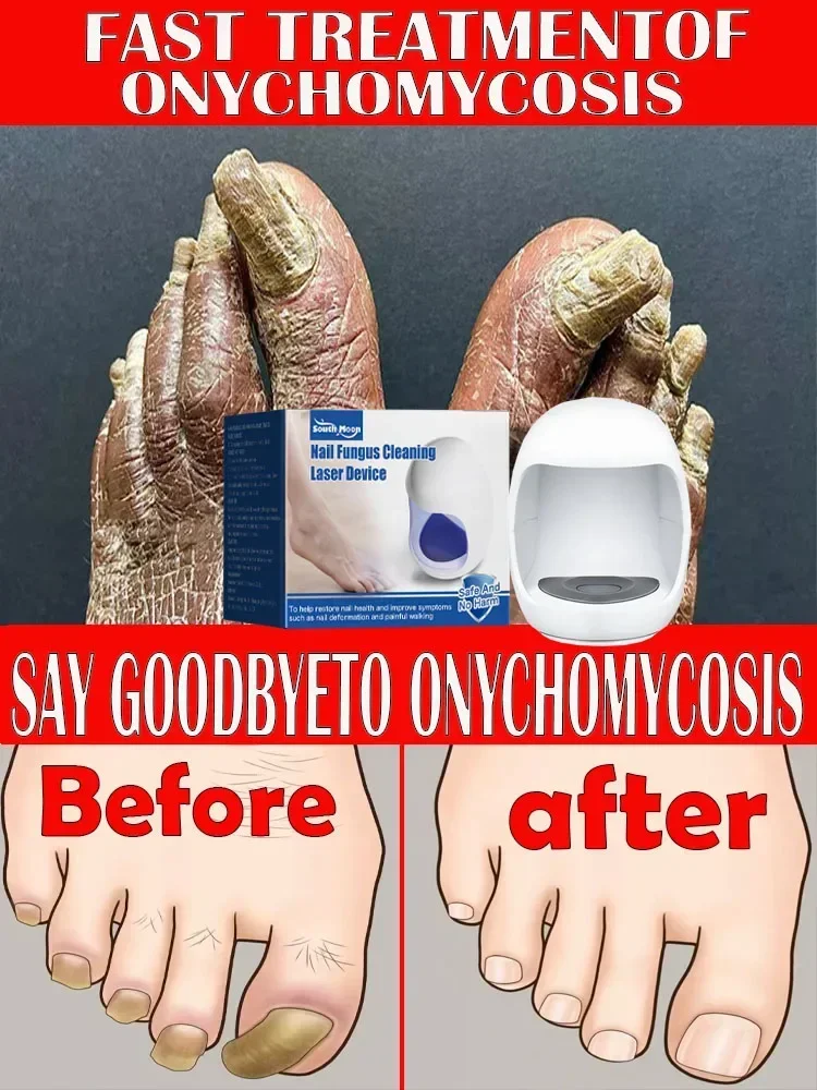 

Fungal Nail Laser Onychomycosis Fungus Nails Repair Fast