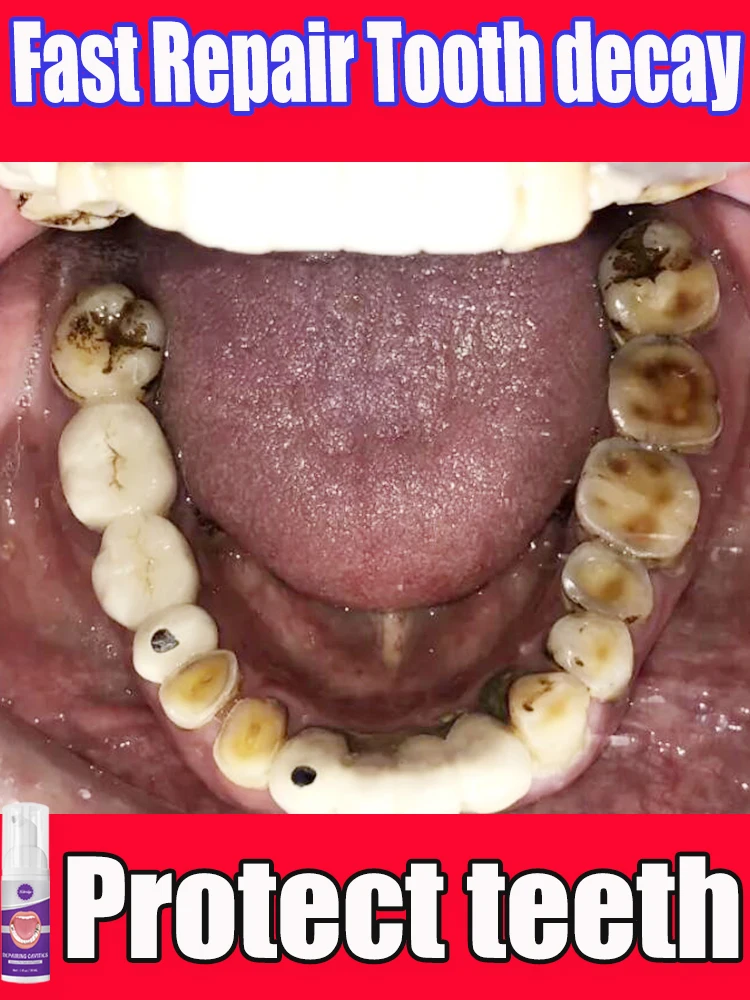 Decay tooth cavities healing anti caries