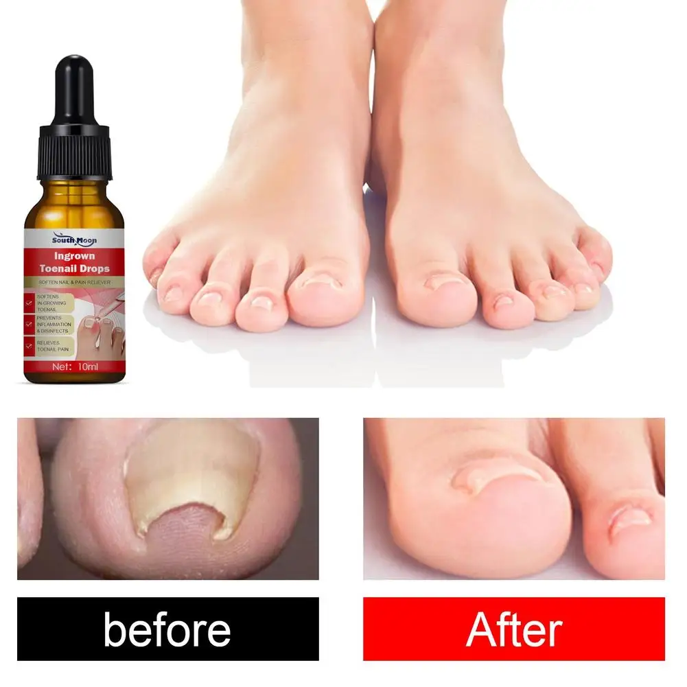 Ingrown Toenail Tratamento Soro, Correção das unhas, Recuperar Óleo, Pain Reliever, Unhas Amaciante, Guarnição com Facilidade Óleo, Saúde Pés, 3 Pcs, 2 Pcs, 1Pc