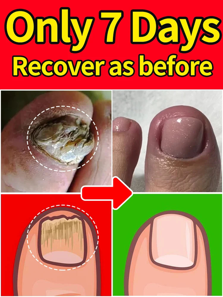 

Anti-athlete's foot fungus nail laser equipment repair essence repair toenails and fingernails treatment onychomycosis mushroom