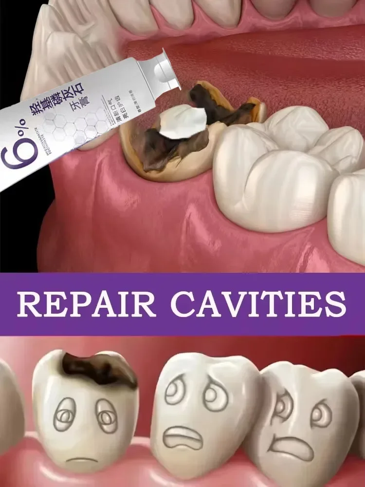 Anti Caries Repairing Cavities Tooth Decay Repair