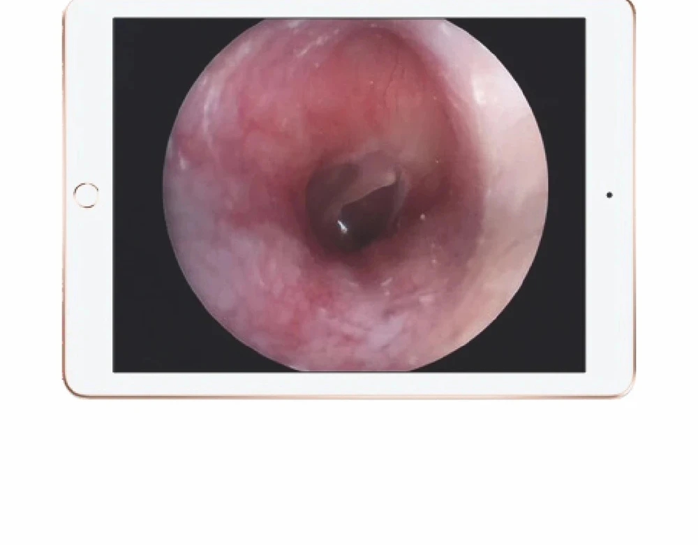 Portable Wireless HD 1080P Wifi Endoscope  for ENT Diagnosis and Surgery Teaching