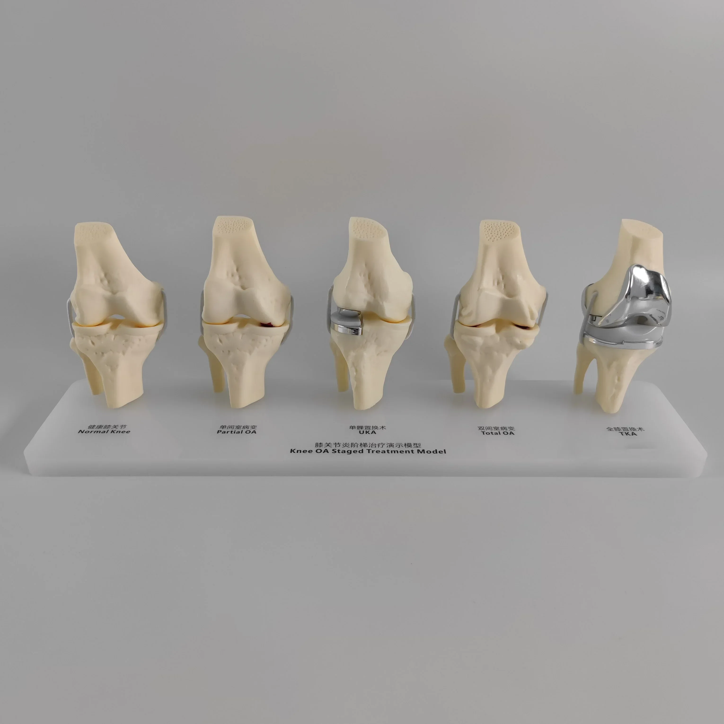 KyrenMed Knee Osteoarthritis Staircase Treatment Model OA Staged 5-stage Knee Replacement Model Knee Insert Model UKA TKA