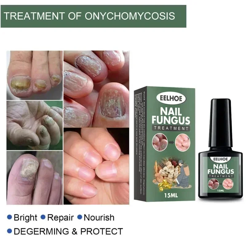 7 Days Nail Fungal Treatment Essence Oil Foot Toe Nail Fungus Removal Serum Repair Toenail Onychomycosi Gel Anti Infection Care