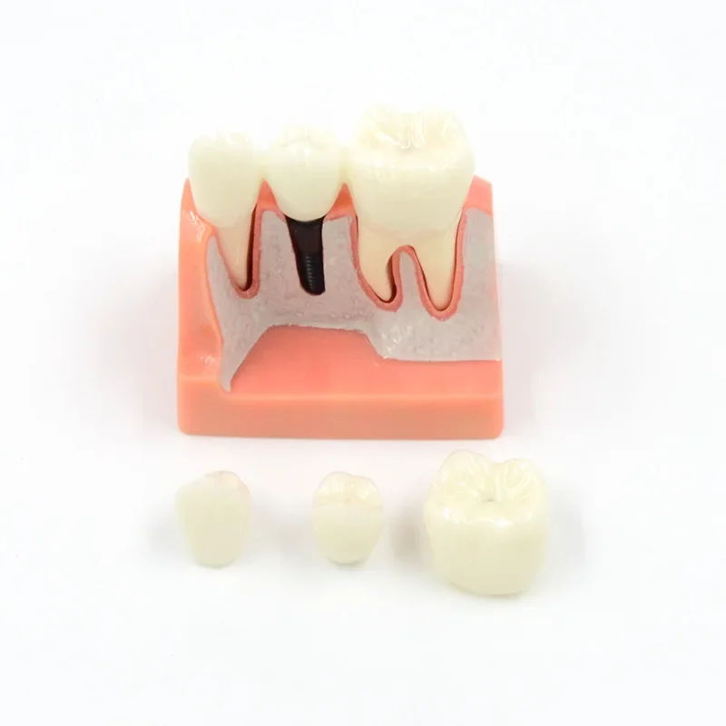 Dental Model 4 Times Dental Implant Analysis Crown Bridge Demonstration Dental Teeth Model Dentist Teaching Dentistry Clinic