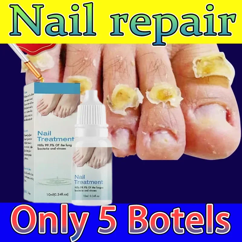 Anti Infection Paronychia Onychomycosis Nail Fungus Treatment Serum Toe Fungal Repair Products Hand Foot Care Removal Gel