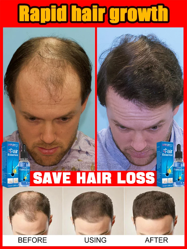 WPRBREGT small blue bottle hair growth essential oil, more hair. Say goodbye to baldness, the secret of thick hair