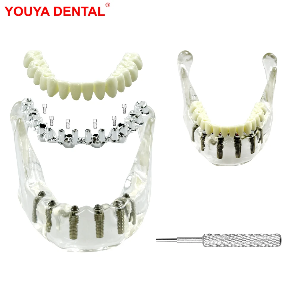 

Dental 6 Implants Mandible Model Dentistry Implant Practice Model Teeth Training Model Teaching Study Dentist-Patient Education