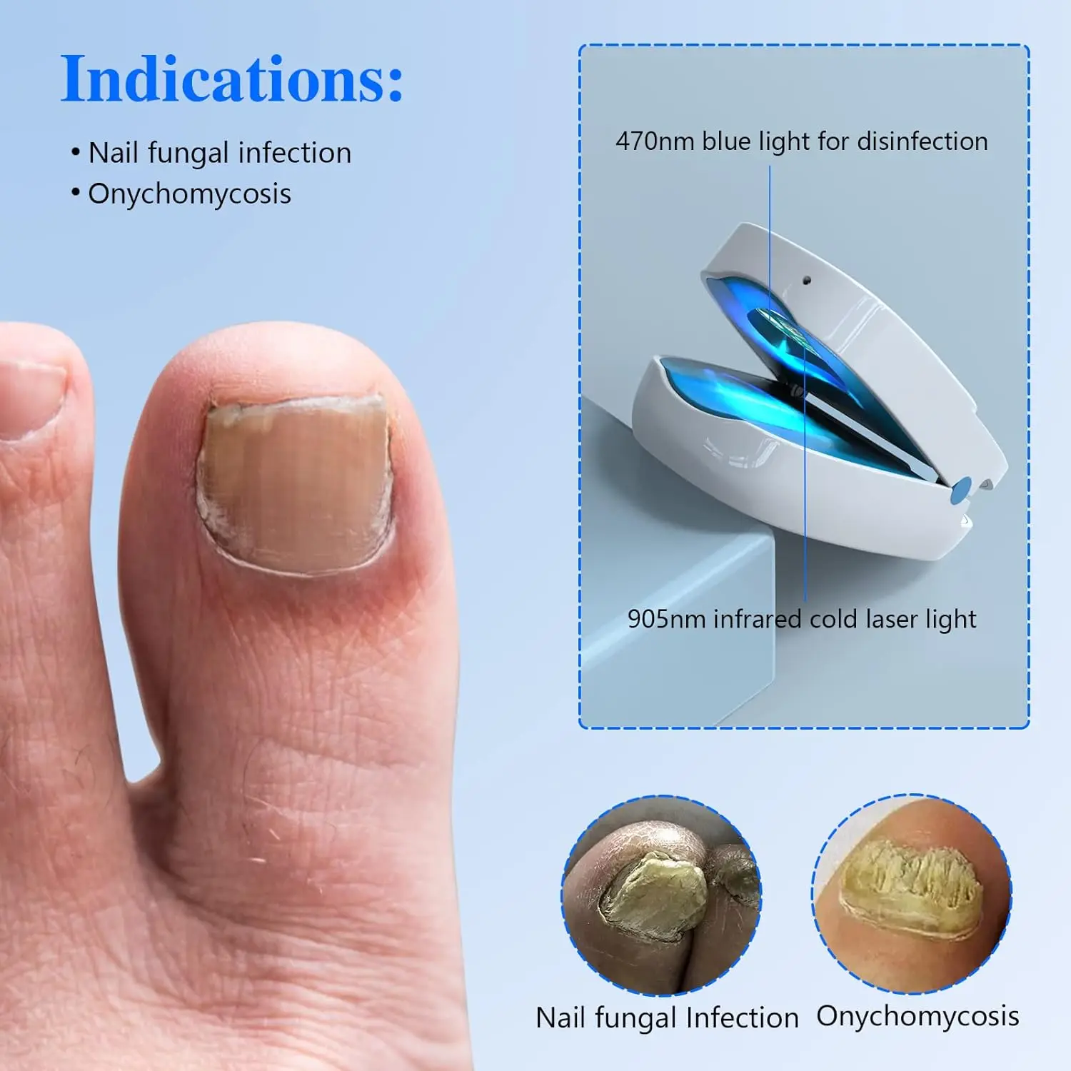 Dispositivo Laser per funghi alle unghie per onicomicosi cura dell\'unghia del piede macchina Laser per piedi dell\'atleta dispositivo per terapia