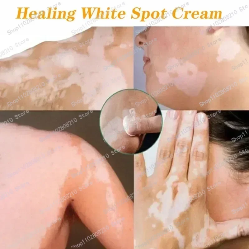 Organic Vitiligo Treatment With Herbal Extract for White Spot Ringworm Removal